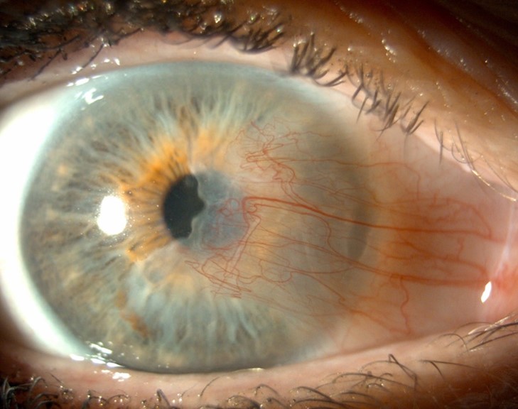 Pterygium onregelmatig gevormd hoornvlies